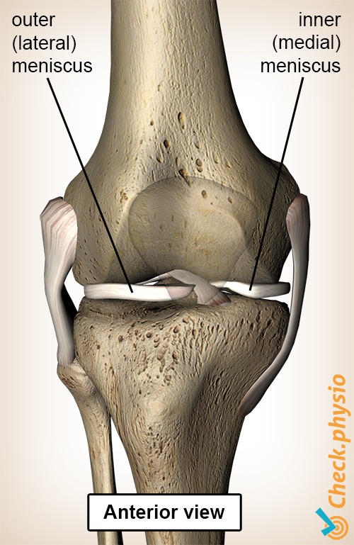 Grinding through injury. Diagram of the knee from the front, illustrating the lateral and medial meniscus.